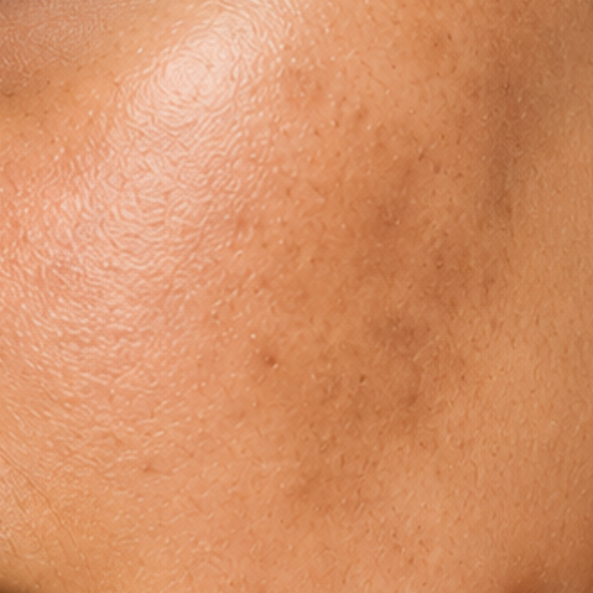 Uneven Skin Tone