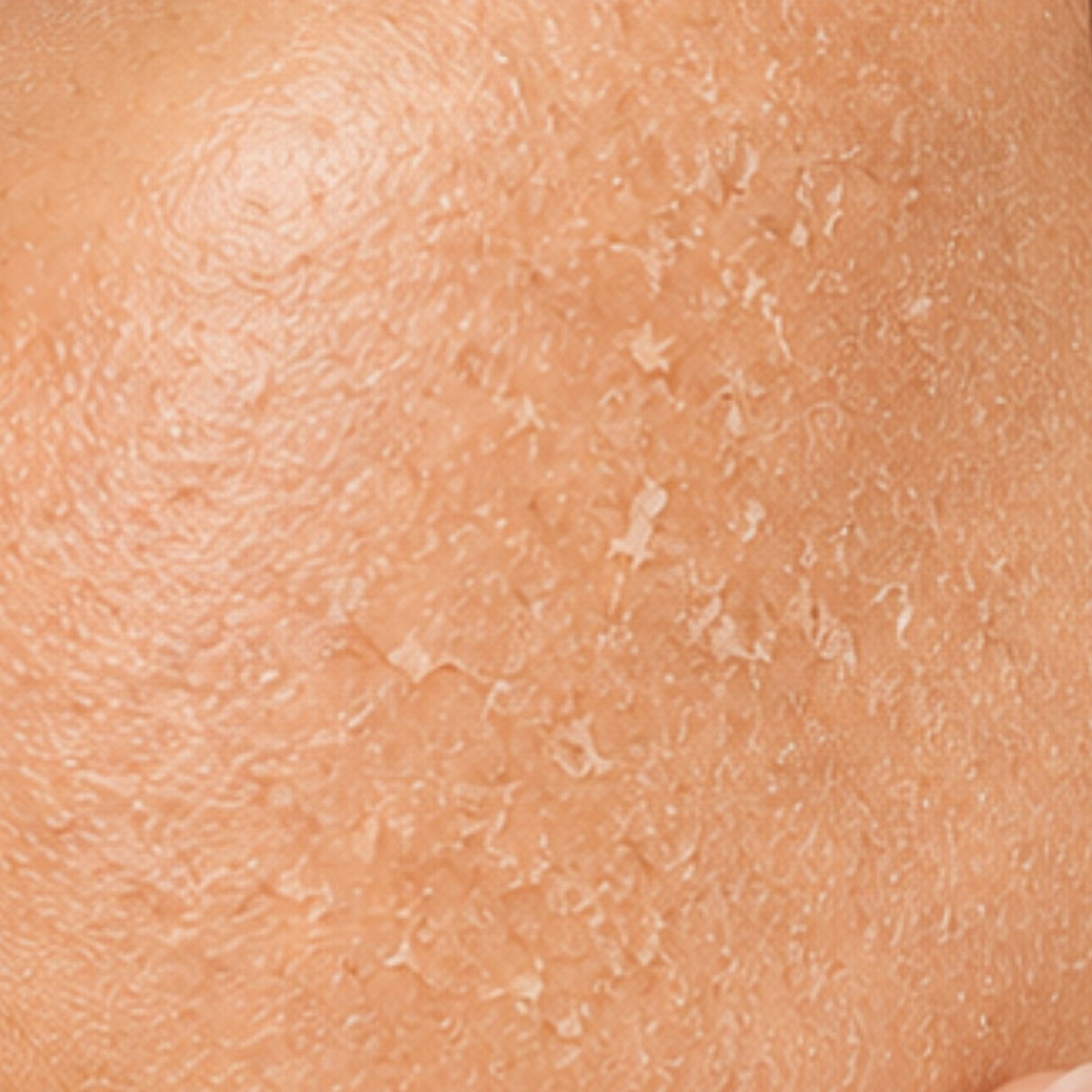 Dry Skin