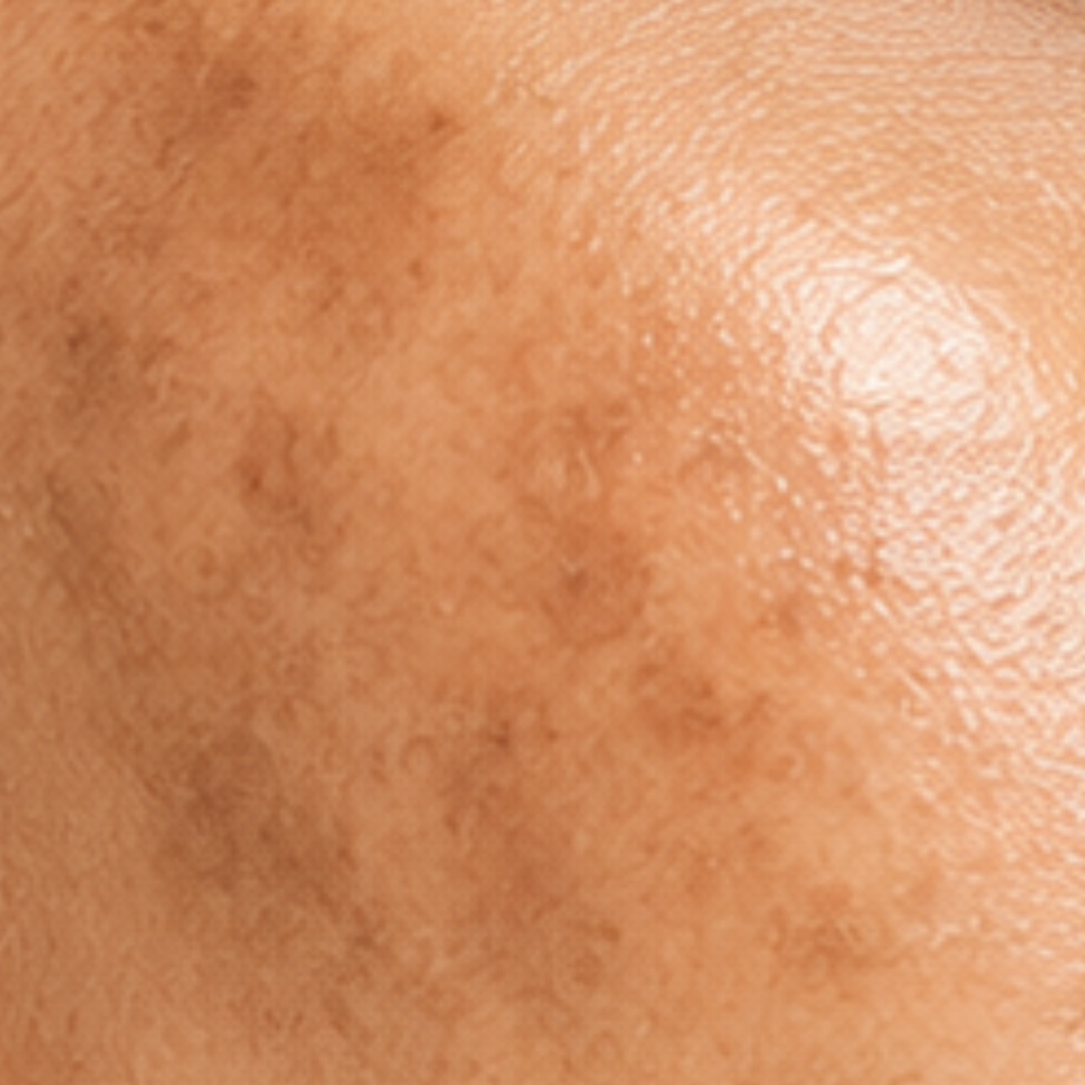 Pigmentation